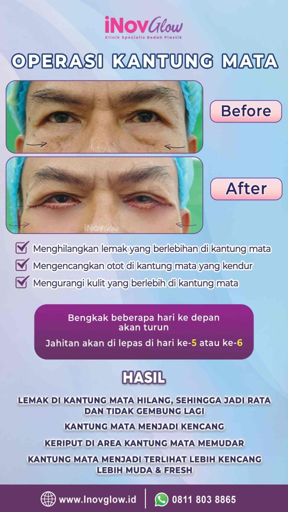 Mau operasi kelopak mata tapi takut hasilnya kaku? 🛑 Pelajari dulu bedanya Brow Lift dan Blepharoplasty di artikel terbaru kami!