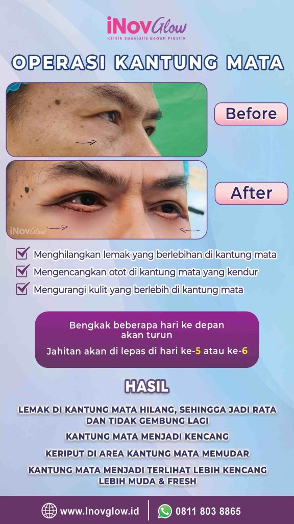 Kantong mata bengkak atau alis yang turun? Ketahui solusi medis terbaiknya dari Dr. Heri Noviana sebelum Anda mengambil tindakan!