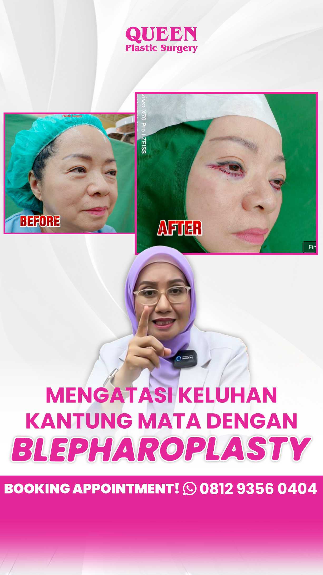 Blefaroplasti berulang? Apakah mungkin? 💉 Cari tahu kapan Anda butuh revisi bersama ahlinya, dr. Heri Noviana, Sp.BP-RE, M.Ked.Klin.