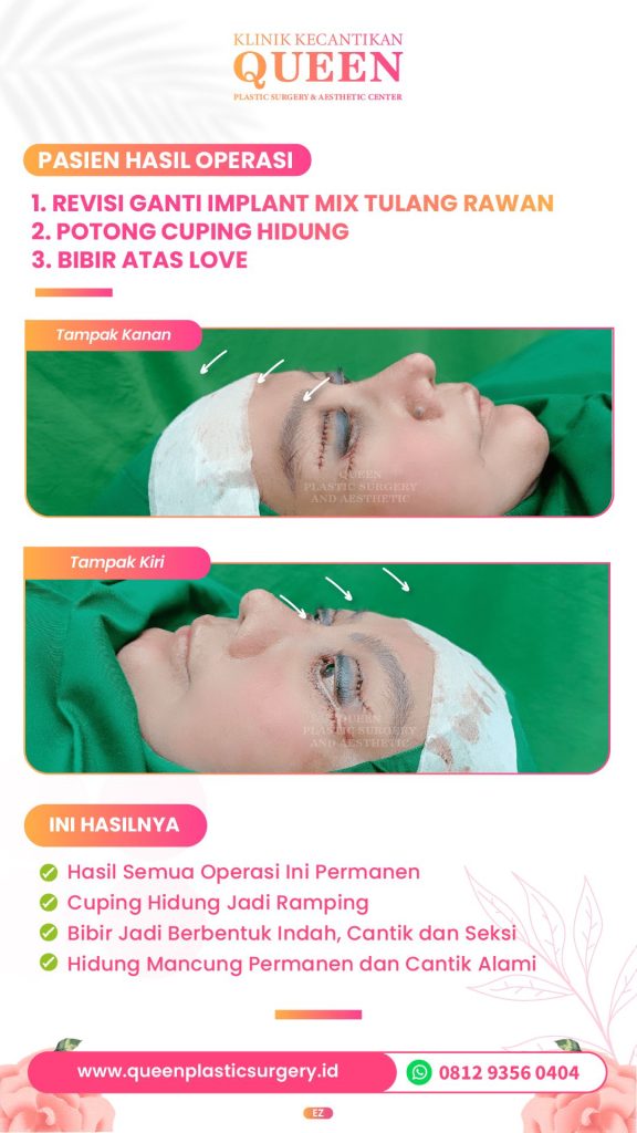Mau hasil Alarplasty yang smooth dan rapi? 🪄 Pastikan kamu tahu fakta ini sebelum masuk ruang operasi. Tanya dr. Heri Noviana sekarang!
