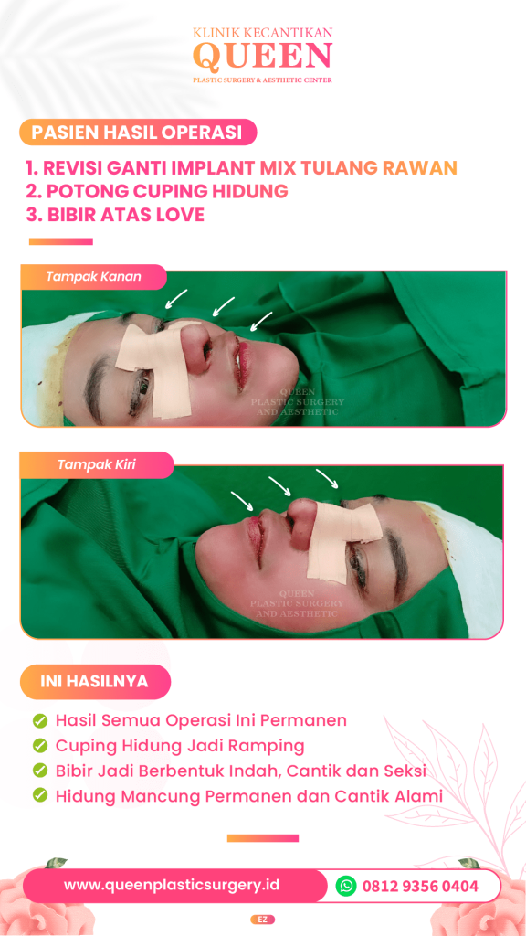 Definisi hidung cantik tanpa harus takut bekas luka. 💖 Simak fakta Alarplasty yang wajib kamu tahu sebelum konsultasi dengan dr. Heri Noviana!