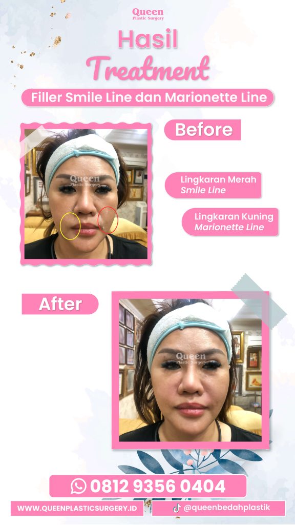 Transformasi senyum lebih kencang dimulai dari sini. 💎 Simak keunggulan Botox garis marionette di artikel dr. Heri Noviana.