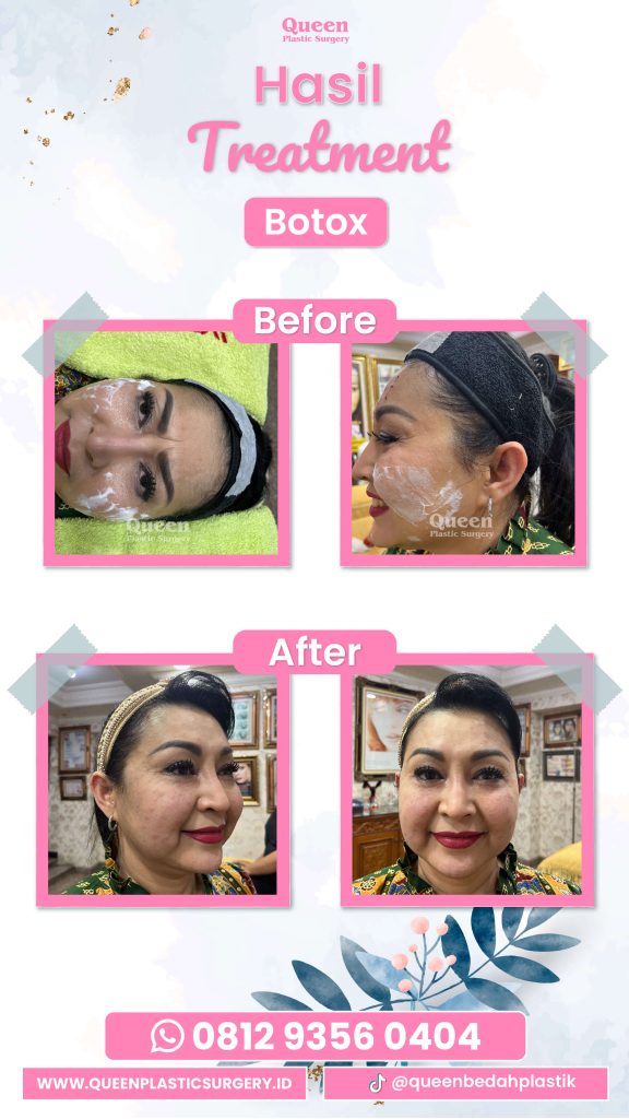 Wajah mulai tampak kendur? 😱 Sebelum pilih perawatan, cek dulu apakah Botox solusinya. Konsultasikan dengan dr. Heri Noviana hari ini!
