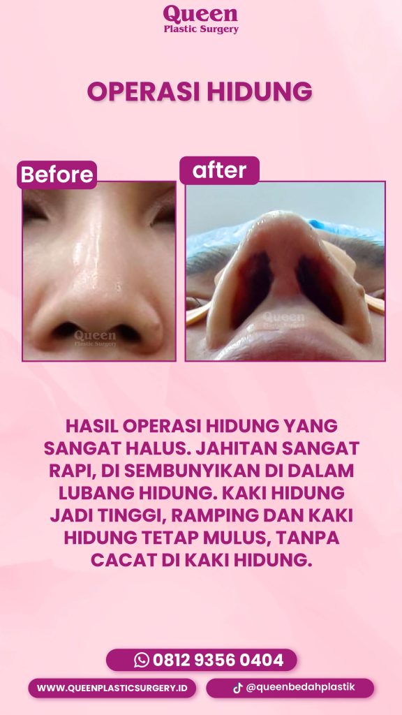 Apa yang terjadi pada bekas luka Alarplasty setelah 1 bulan? 📅 Temukan jawabannya dan konsultasikan dengan dr. Heri Noviana!