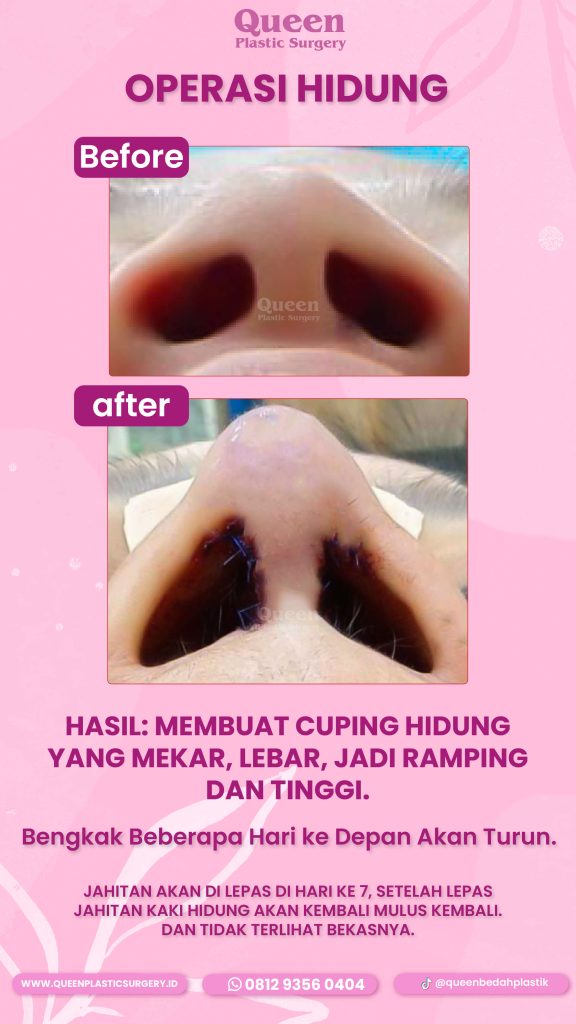 Hidung ramping maksimal, bekas luka minimal! 💎 Intip teknik Alarplasty modern dari dr. Heri Noviana yang bikin kamu makin percaya diri.