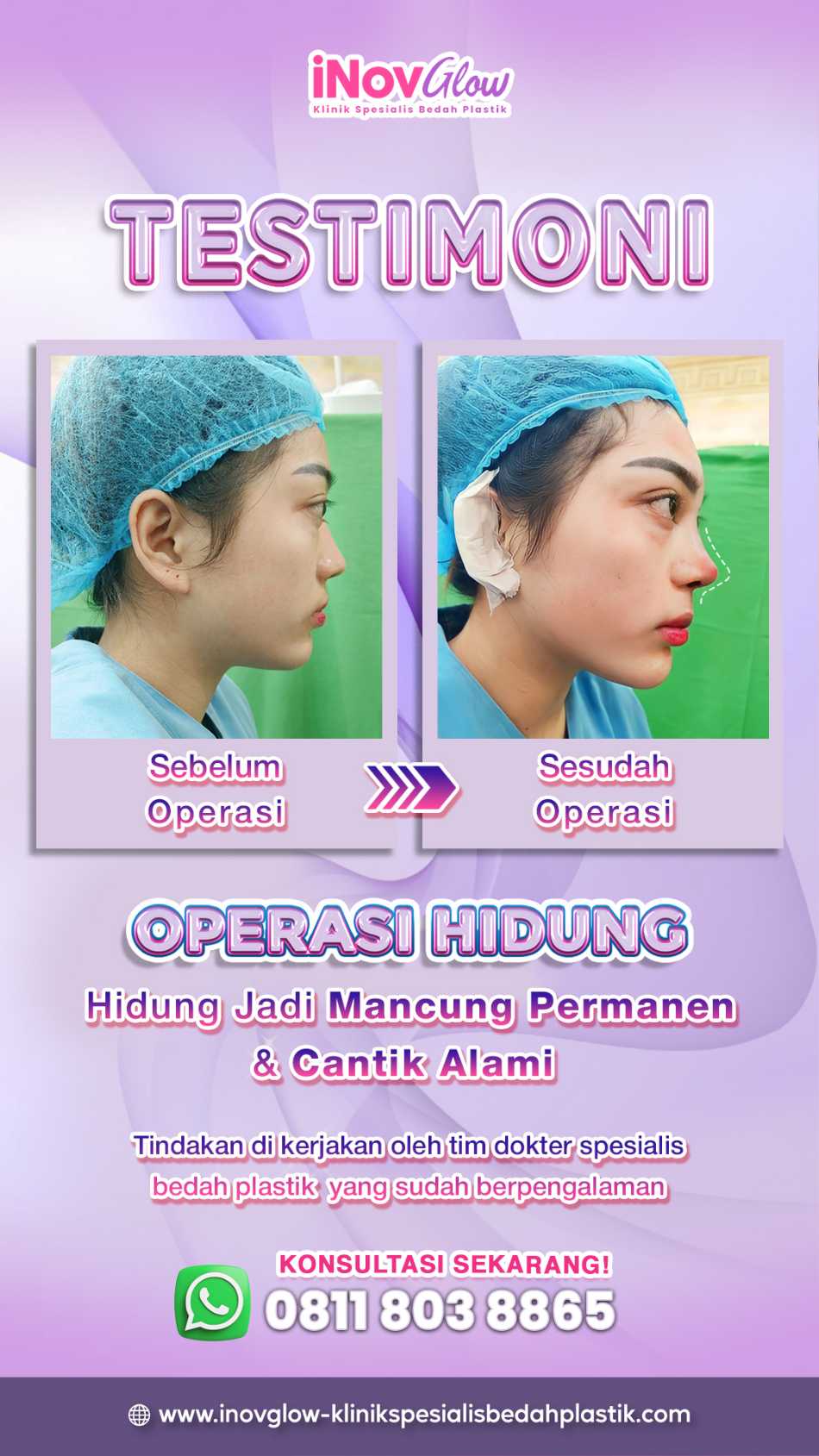 Jangan sepelekan bersin setelah operasi hidung! 🛑 Bisa berakibat fatal buat hasil akhir Rhinoplasty Anda. Cek penjelasan Dr. Heri Noviana di sini.