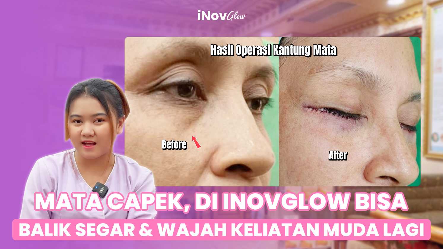 Jangan biarkan dibilang lelah terus! 🛑 Bongkar rahasia mata segar tanpa kantung mata permanen dari Dr. Heri Noviana di sini.