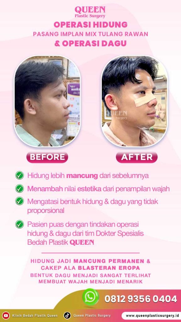 Bukan oplas total! Cukup kecilkan cuping hidung, wajah langsung berubah drastis. 😲 Simak penjelasan medis Dr. Heri Noviana di sini.
