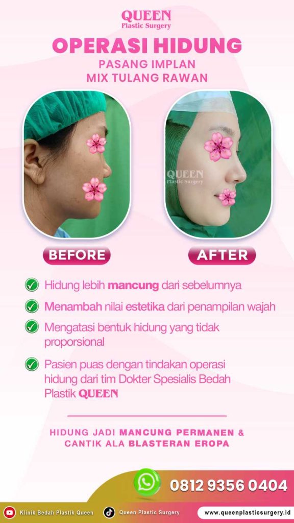 Solusi hidung proporsional yang minim bekas luka! 💎 Kupas tuntas prosedur Alarplasty modern bersama Dr. Heri Noviana hanya di artikel ini.