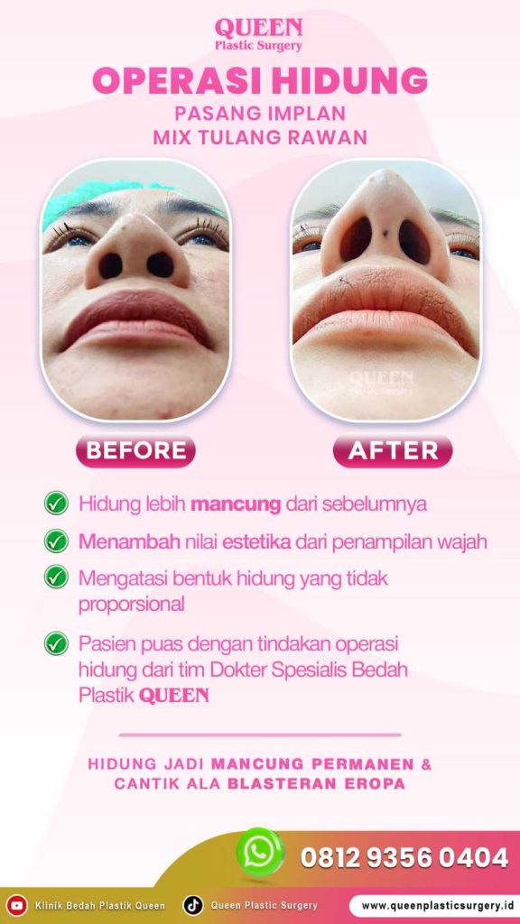 Mau Alarplasty tapi takut lubang hidung jadi kekecilan? 🛑 Ketahui teknik presisi dari Dr. Heri Noviana agar hasil tetap natural!