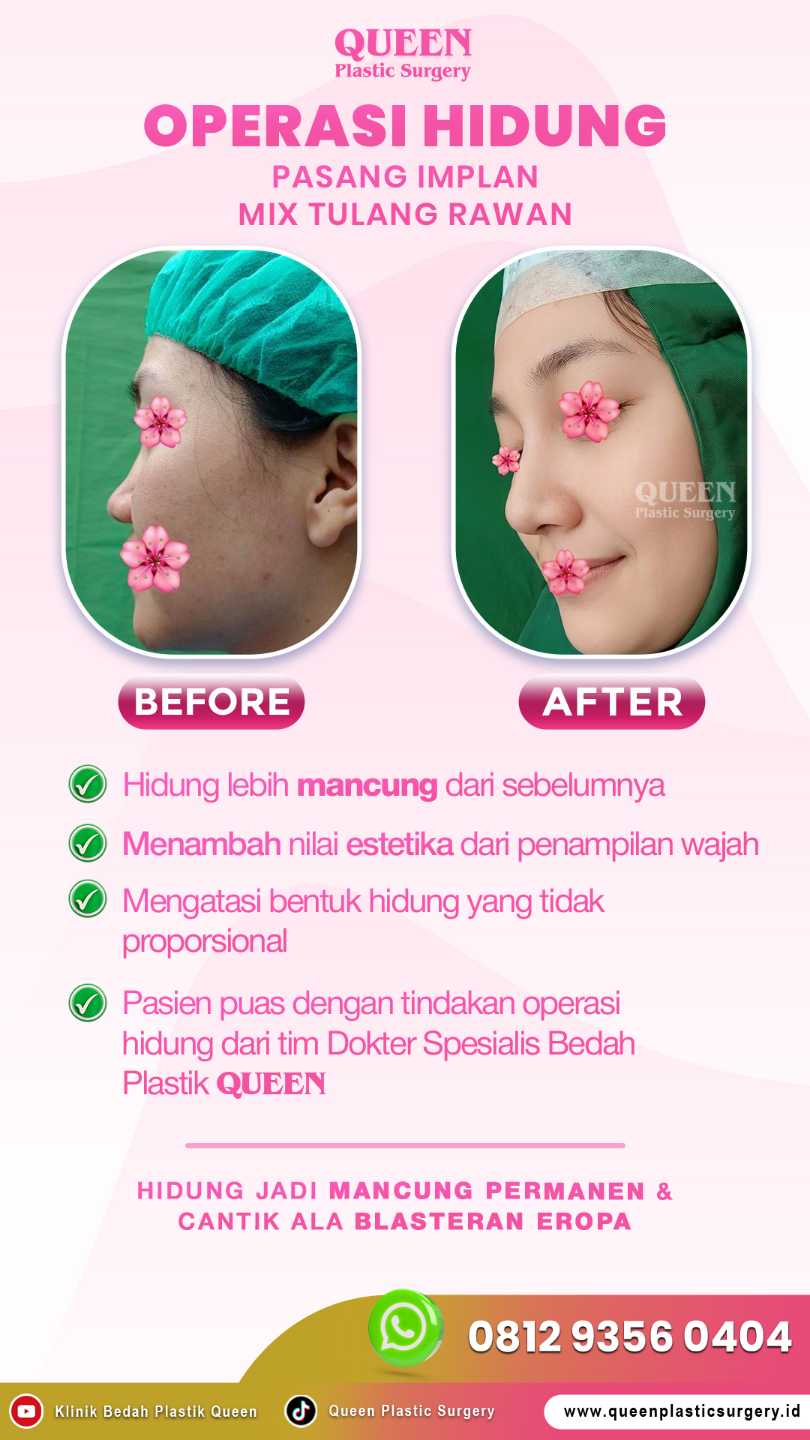 Bentuk cuping hidung ideal yang menyatu sempurna dengan wajah Anda. ✨ Intip rahasia pemulihan cepat Alarplasty dari Dr. Heri Noviana.