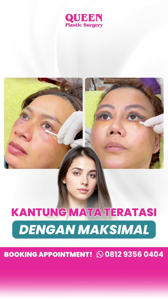 Rahasia terbebas dari kantung mata bertahun-tahun! Sudah tahu cara kerja blepharoplasty belum?