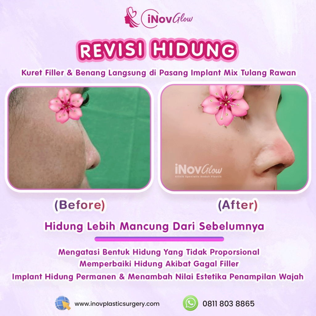 Mengapa Rhinoplasty Revisi lebih rumit dari operasi pertama? 🧠 Simak penjelasan penting Dr. Heri Noviana agar hasilnya tidak gagal lagi.