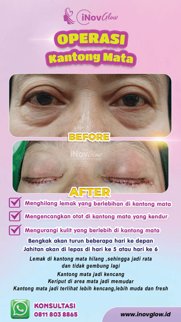 Sering dianggap sama, padahal fungsinya beda jauh! Jangan salah pilih antara Brow Lift atau Blepharoplasty. Cek panduannya di sini.