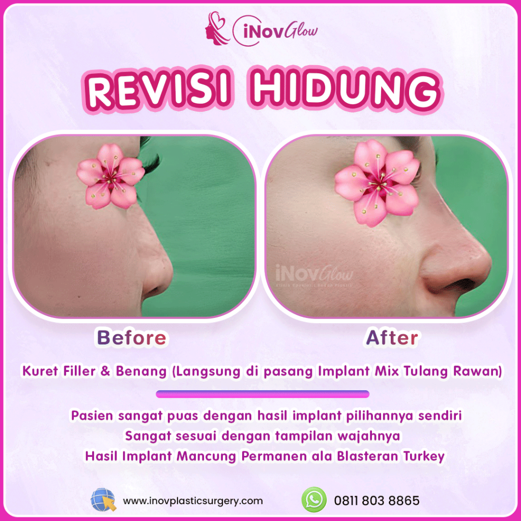 Rahasia memperbaiki struktur hidung yang rusak akibat operasi sebelumnya. 👃 Intip penjelasannya medisnya dari Dr. Heri Noviana sekarang!