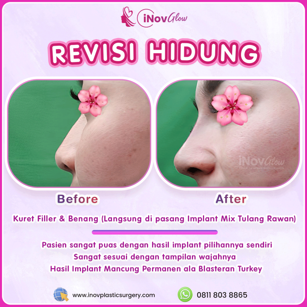 Hidung terasa sakit atau implan bergeser setelah operasi? 🛑 Jangan tunggu parah! Simak solusi revisi dari Dr. Heri Noviana sekarang.