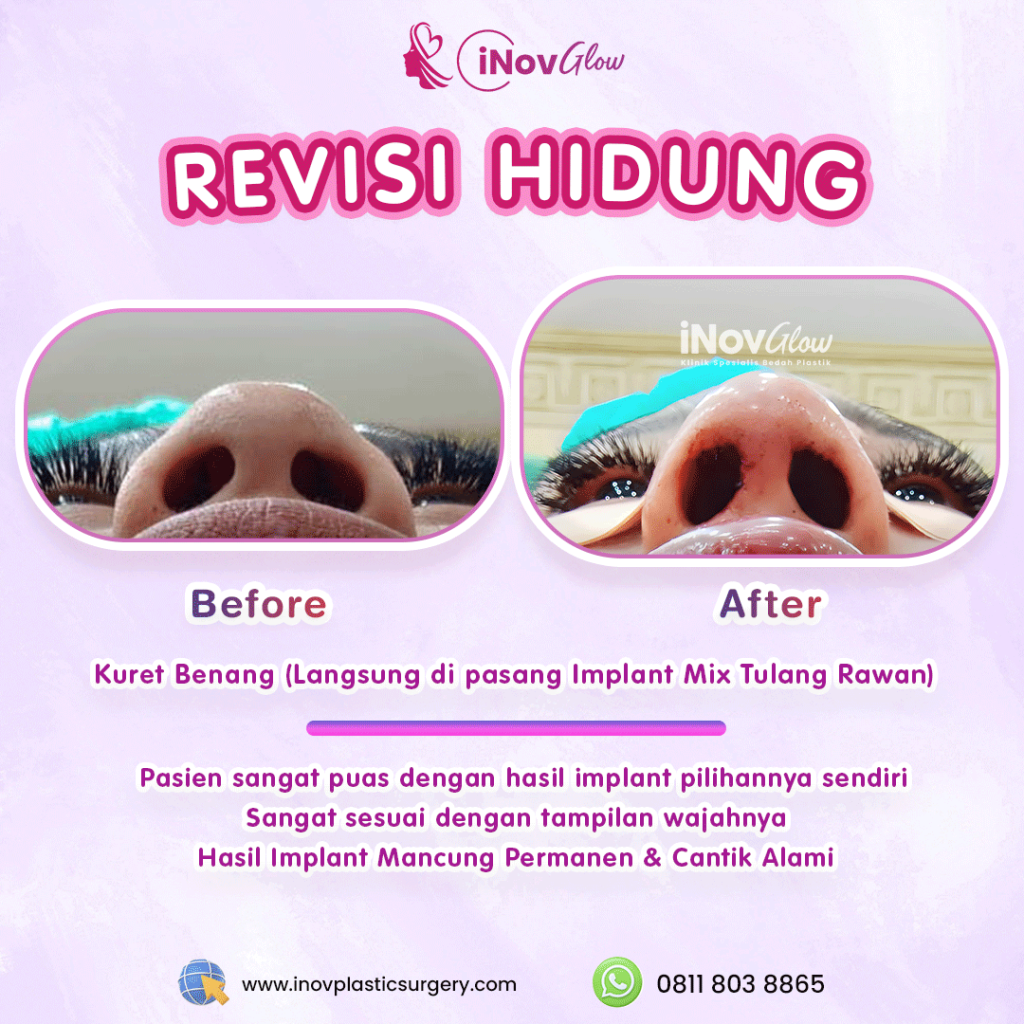 Operasi hidung gagal bukan akhir dari segalanya. 🛡️ Ketahui teknik Rhinoplasty Revisi yang aman bersama ahlinya, Dr. Heri Noviana.