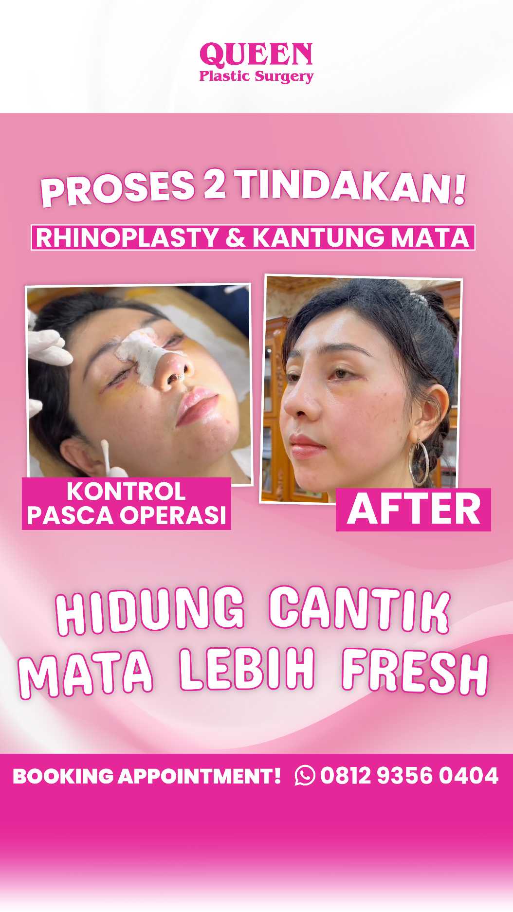 Sudah Blefaroplasti tapi mata tetap terlihat lelah? 😴 Jangan abaikan tanda-tanda ini. Simak edukasi medis dr. Heri Noviana di sini!