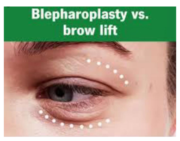 Mata terlihat lelah padahal sudah cukup tidur? 🤔 Ketahui apakah Anda butuh Brow Lift atau Blepharoplasty di sini! Konsultasikan dengan Dr. Heri Noviana sekarang.