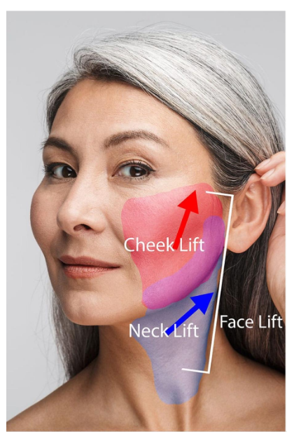 Wajah tampak 15 tahun lebih muda bukan cuma mimpi! ✨ Lower Facelift vs Neck Lift, mana rahasia terbaiknya? Temukan jawabannya bersama Dr. Heri Noviana.