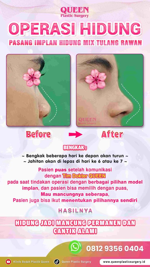 Bosan pakai perban hidung dan pengen cepat tampil sosialita lagi? 💅 Pelajari cara aman mempercepat pemulihan bersama Dr. Heri Noviana.