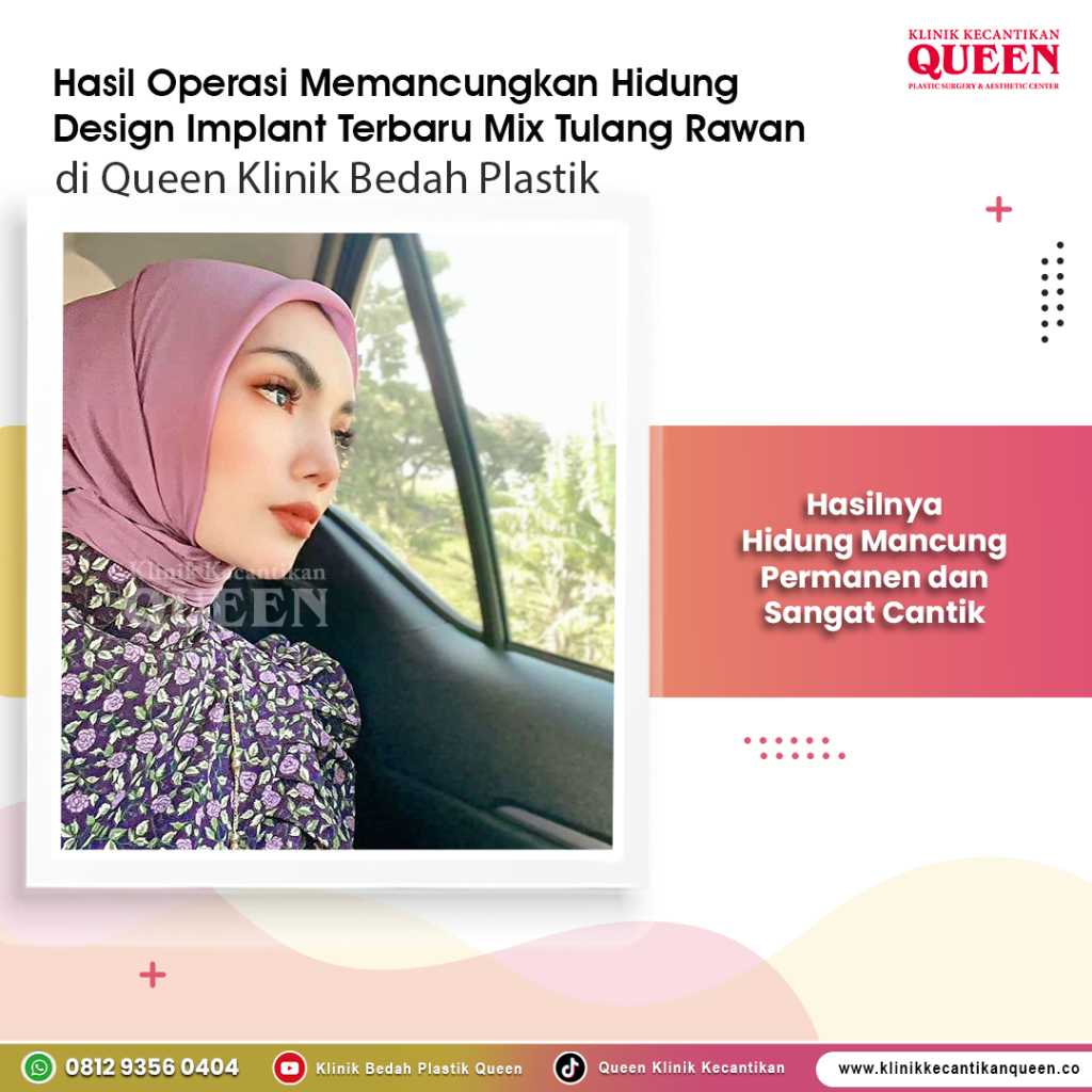 Kembalikan rasa percaya diri Anda dengan bentuk hidung yang simetris dan aman. 📈 Simak panduan lengkap revisi bersama Dr. Heri Noviana hanya di sini!