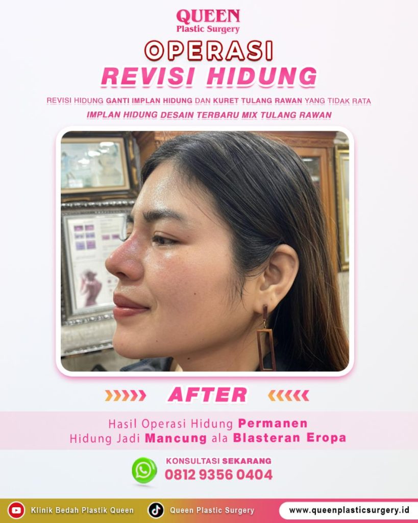 Jangan buru-buru pasang implan sebelum tahu material alami yang satu ini! 🛑 Simak ulasan keunggulan tulang rawan rusuk dari Dr. Heri Noviana, Sp.BP-RE, M. Ked. Klin