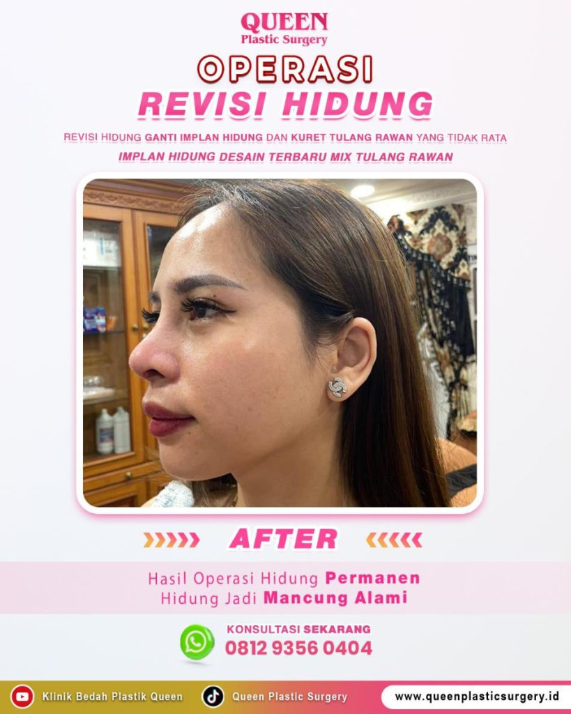 Hidung mancung sempurna, aman dari risiko implan jebol atau infeksi! 🙅♀️ Ketahui rahasia teknik tulang rawan rusuk dari Dr. Heri Noviana, Sp.BP-RE, M. Ked. Klin disini.