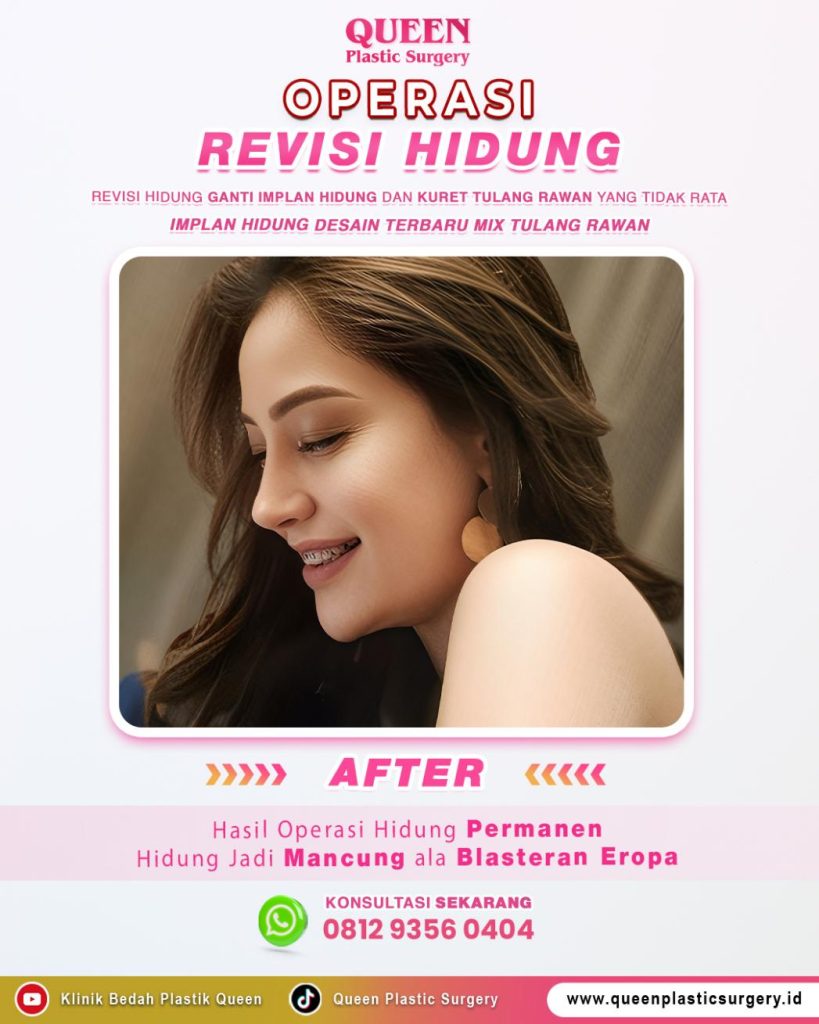 Rhinoplasty pakai tulang rawan rusuk, apa kehebatannya dibanding implan? 🤔 Cari tahu manfaat luar biasanya bersama Dr. Heri Noviana, Sp.BP-RE, M. Ked. Klin di sini.