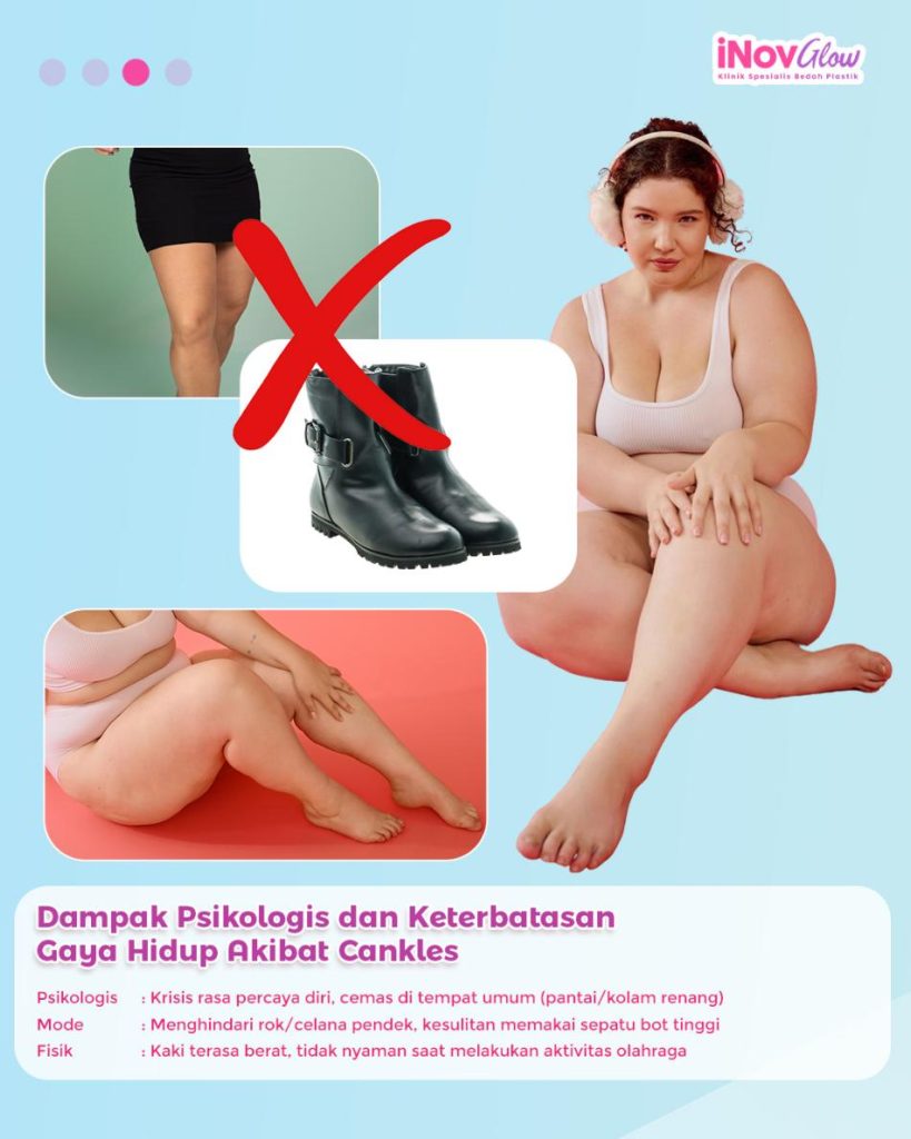 Kupas tuntas Liposuction betis dan pergelangan kaki! 🦵 Hubungi Dr. Heri Noviana sekarang untuk jadwalkan konsultasi kontur tubuh Anda.