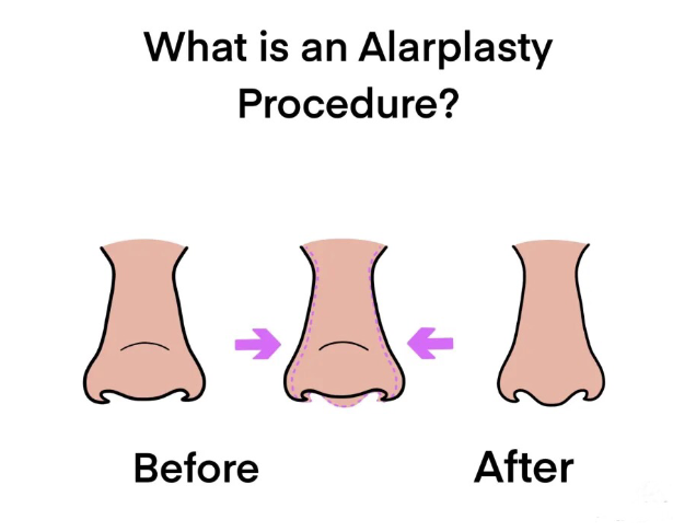 Rahasia lubang hidung simetris dan proporsional akhirnya terungkap! ✨ Yuk, intip panduan Alarplasty modern dari Dr. Heri Noviana, Sp.BP-RE, M.Ked.Klin