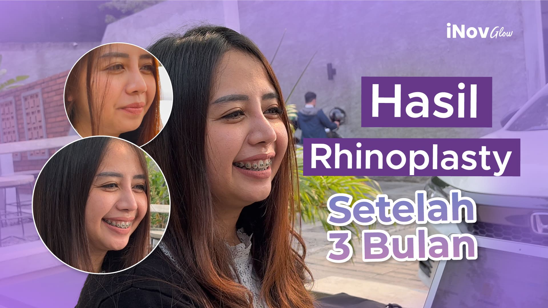 Bukan sekadar potong atau mancungin hidung! Ini dampak psikologis luar biasa pasca-Rhinoplasty yang jarang dibahas. Simak kata Dr. Heri Noviana.