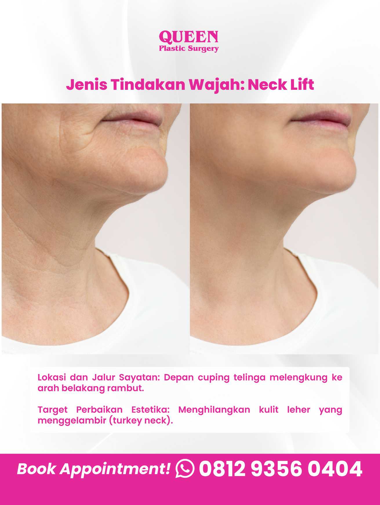 Facelift vs Tarik Benang: Mana yang memberikan hasil kencang jangka panjang dan paling hemat? 🧐 Cari tahu jawabannya dari Dr. Heri Noviana!