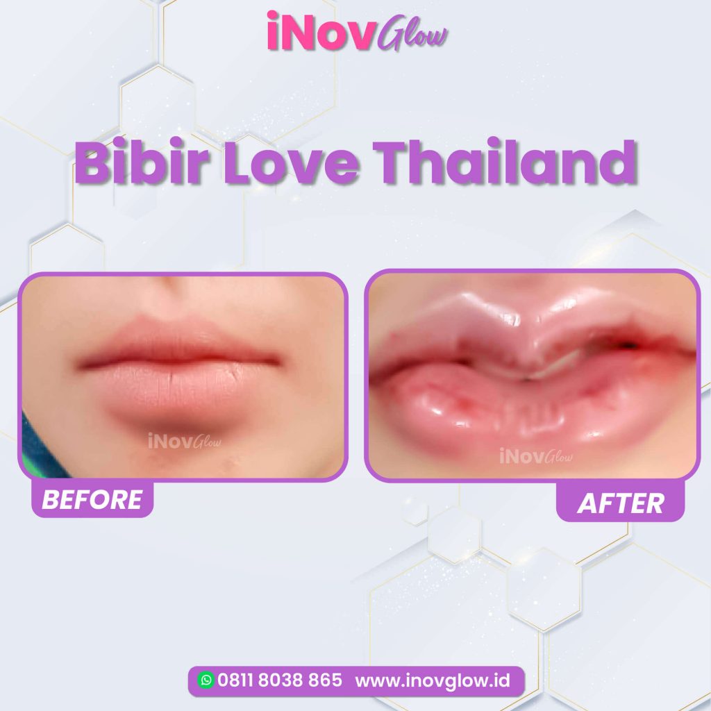 Mau bibir seksi permanen tapi takut terlihat kaku atau 'dower'? 🙅‍♀️ Ketahui teknik presisi Implan Bibir natural dari Dr. Heri Noviana!