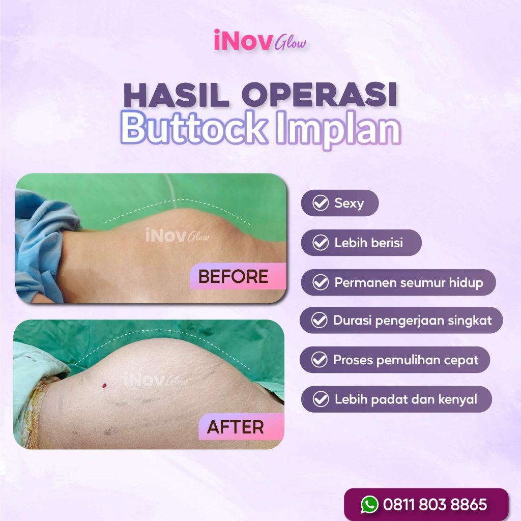 Mau hasil bokong kencang, padat, dan bulat alami tanpa terlihat kaku? 🎭 Temukan teknik paling pas untuk Anda bersama Dr. Heri Noviana.