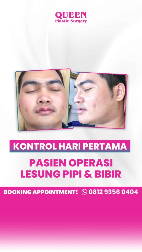 Khawatir prosedur Lip Flip bakal bikin sulit minum pakai sedotan atau mengganggu fungsi bicara? 🩹 Cek fakta medisnya dari Dr. Heri Noviana.