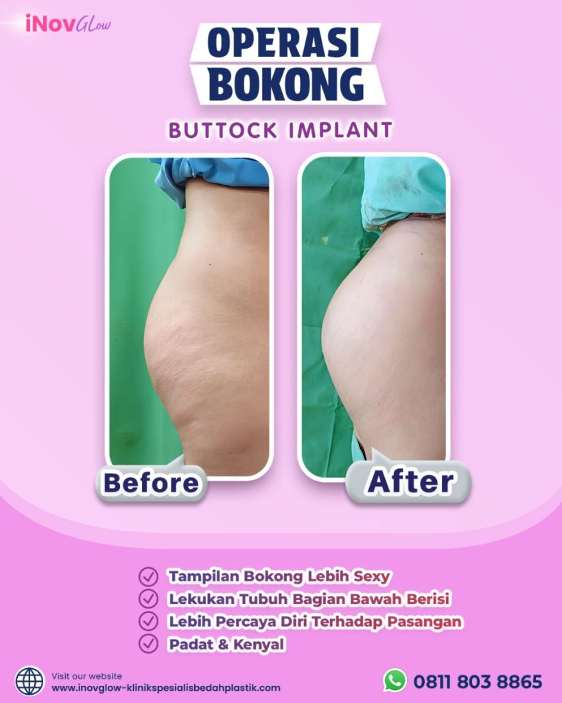 Tambah volume atau buang kulit kendur? 📐 Pahami target area Implan Bokong vs Butt Lift dari penjelasan Dr. Heri Noviana.