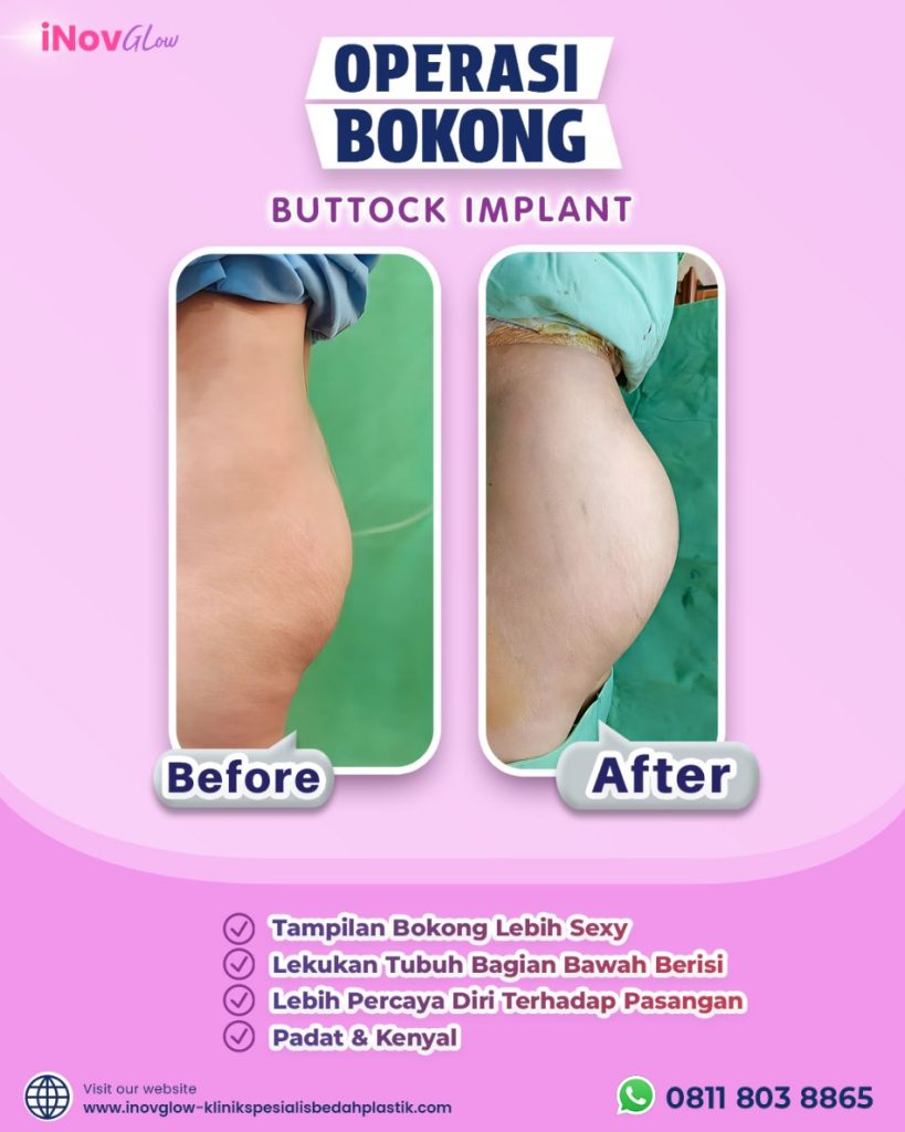 Solusi jitu mendapatkan body goals impian secara aman. 🌟 Intip rahasia pemilihan prosedurnya bersama Dr. Heri Noviana di artikel terbaru ini.