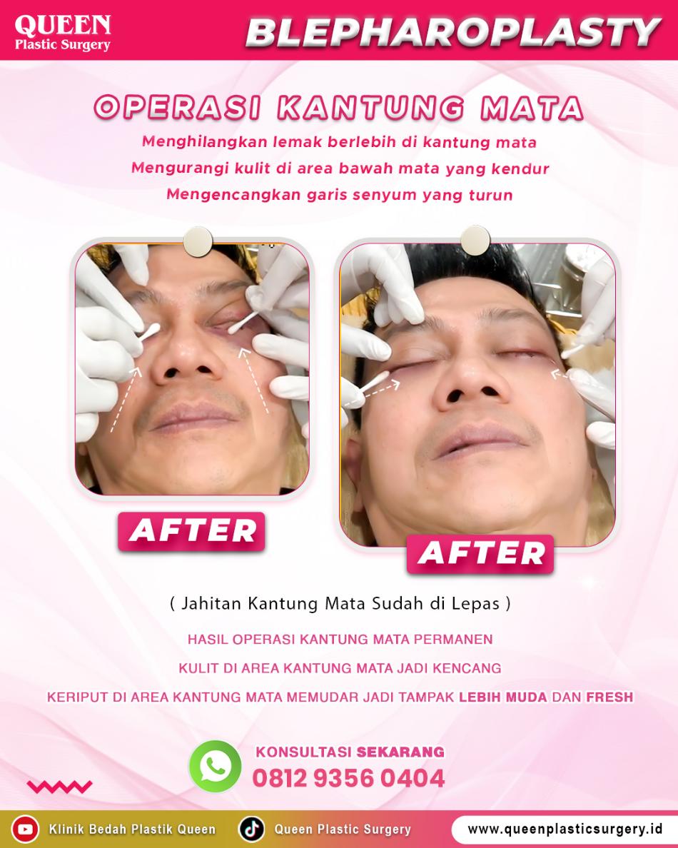 Jangan salah pilih perawatan! Ini rahasia beda masalah kantung mata vs mata panda menurut medis.