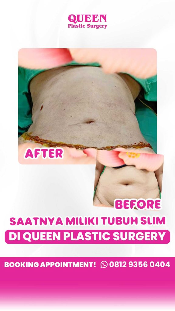 Rahasia membuang kulit kendur dan menjahit kembali otot perut yang robek agar rata seketika. ✨ Simak penjelasan Dr. Heri Noviana!