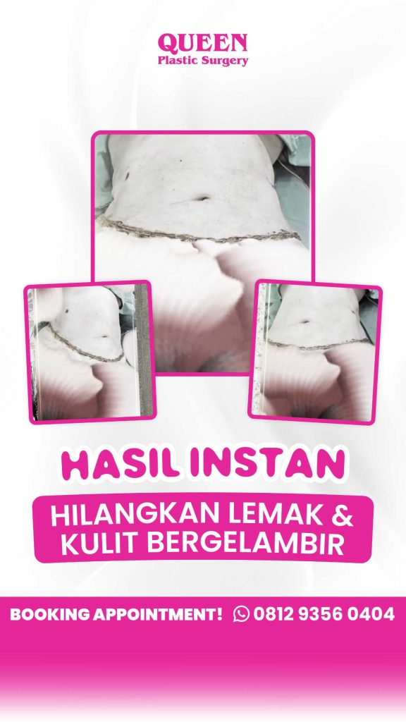 Kupas tuntas perbedaan hasil antara sekadar sedot lemak vs tindakan Tummy Tuck bersama Dr. Heri Noviana!