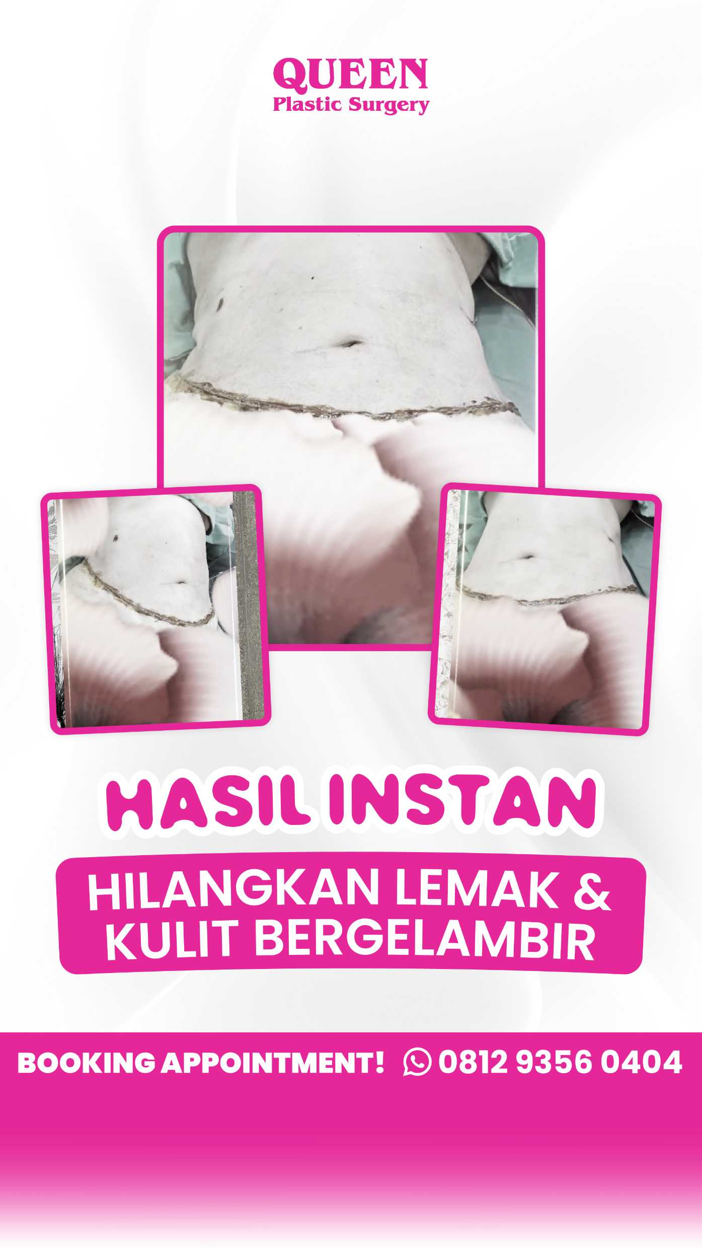 Kupas tuntas perbedaan hasil antara sekadar sedot lemak vs tindakan Tummy Tuck bersama Dr. Heri Noviana!