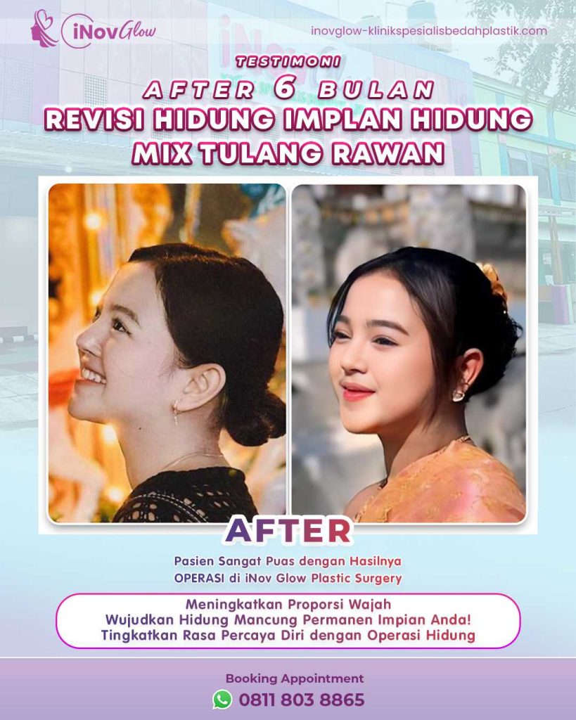 Ucapkan selamat goodbye pada bentuk hidung pesek atau bengkok yang bikin kurang pede! 👋 Pilih solusi cangkok tulang rawan dalam Rhinoplasty dari Dr. Heri Noviana."