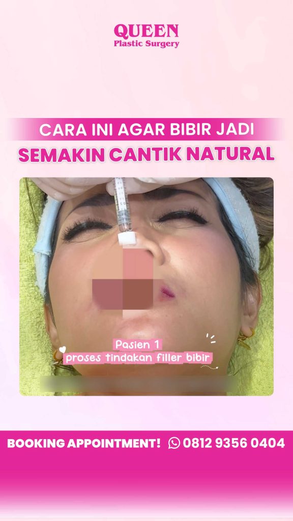 Kupas tuntas Filler Bibir vs Implan Bibir! 👄 Mana yang paling tepat untuk Anda? Hubungi Dr. Heri Noviana untuk konsultasi sekarang.