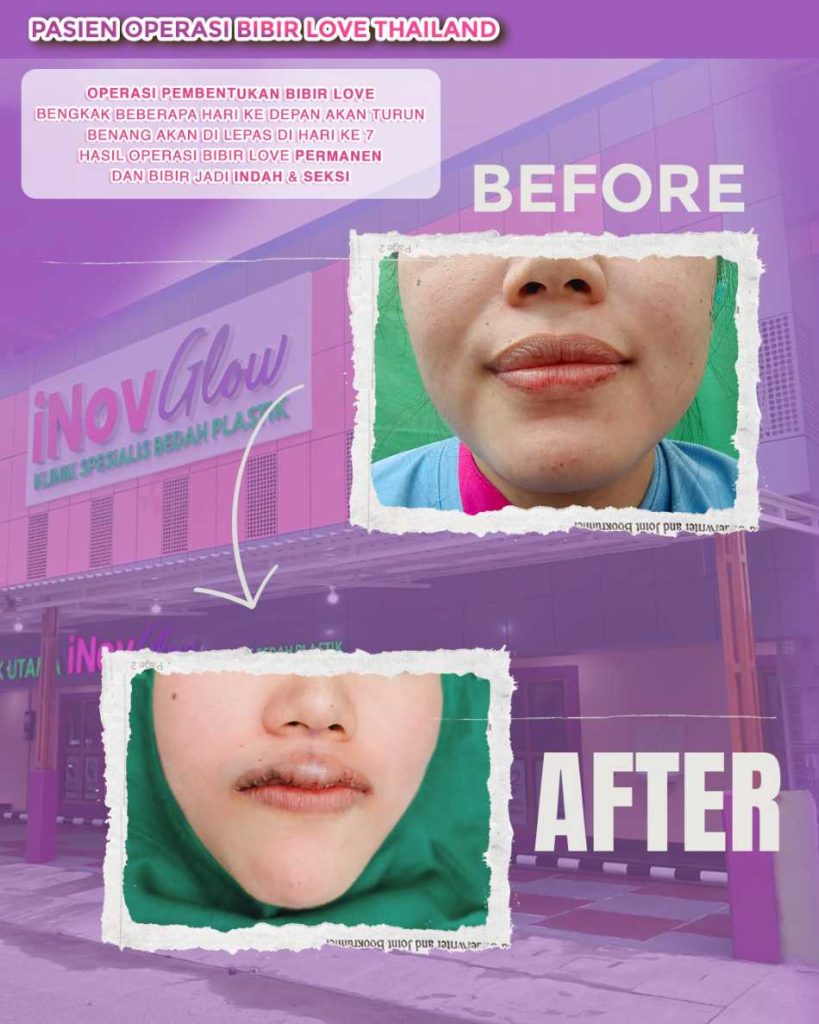 Bentuk bibir seksi ideal yang menyatu sempurna dengan senyuman Anda. 🌟 Intip rahasia keamanan Implan Bibir dari Dr. Heri Noviana di artikel ini!