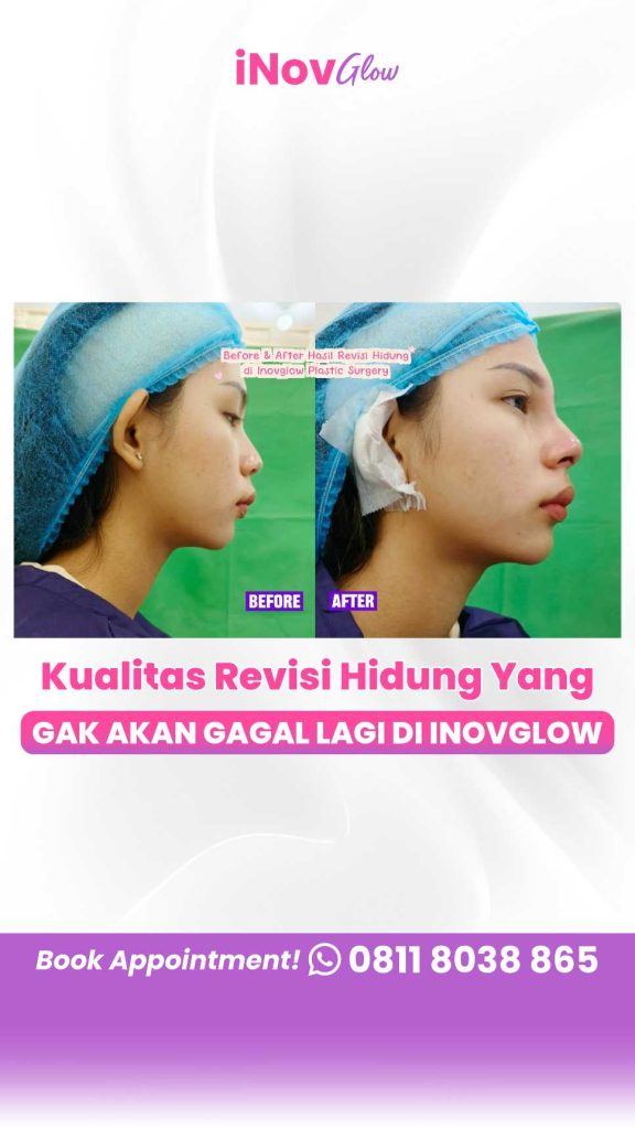 Mau proses pemulihan operasi hidung berjalan mulus walau harus tetap bekerja pakai kacamata? 📈 Ikuti aturan aman dari Dr. Heri Noviana.