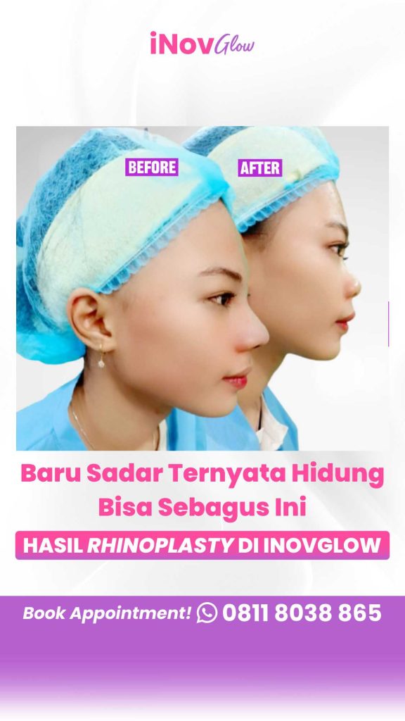 Panduan anti-gagal memakai kacamata setelah operasi hidung! 👓 Amankan struktur hidung baru Anda dengan tips proteksi dari Dr. Heri Noviana.