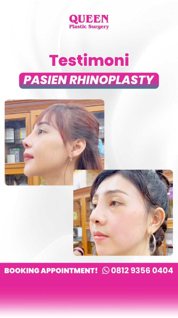 Miliki kembali bentuk hidung impian yang harmonis dan proporsional seumur hidup. 📈 Simak panduan Dr. Heri Noviana hanya di artikel ini!
