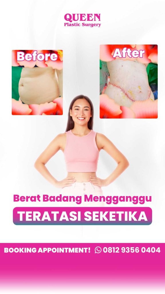 Apakah operasi Tummy Tuck bisa meratakan perut buncit membandel secara permanen? 🧐 Temukan jawaban Dr. Heri Noviana!