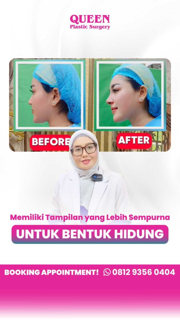 Rahasia ujung hidung (tip) cepat tirus dan bebas bengkak sisa setelah operasi. 😲 Cek bocoran tips medis dari Dr. Heri Noviana di sini!
